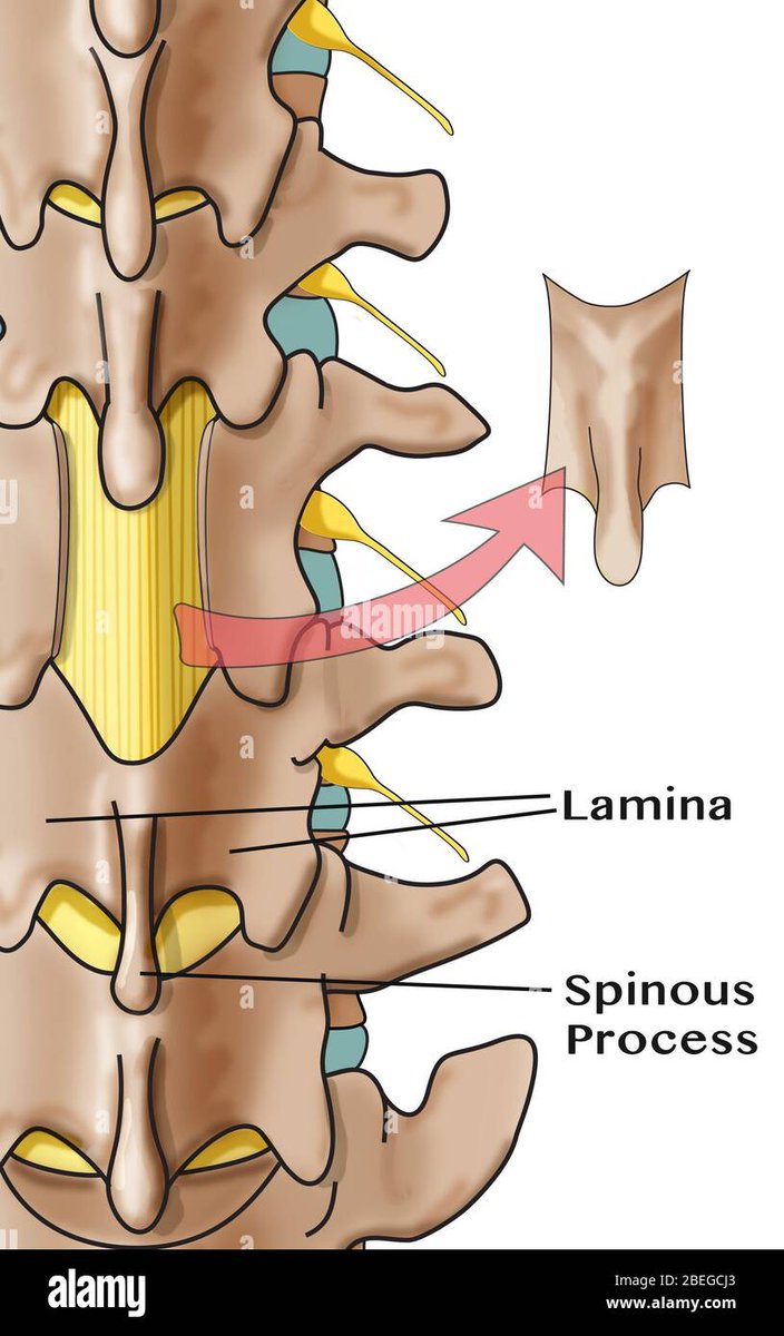 #CaudaEquinaSyndrome #SpinalCordInjury #SpinalDecompression