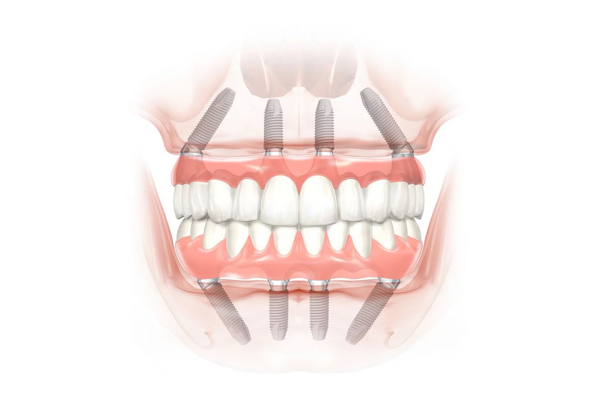 Имплантация All-on-4: инновационный метод протезирования для пациентов с полной потерей зубов
on-woman.com/implantaciya-n…
#полнаяпотерязубов #протезированиезубов #allon4 #имплантациязубов