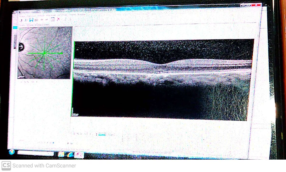 DrMG_PsychMD's tweet photo. After a week of investigation which suggested some ocular problems, he presented to the OPD with added problems of "#metamorphopsia" This led to further differential diagnosis. A visual acuity check led to prescription glasses. https://t.co/BSnBNRqC1r