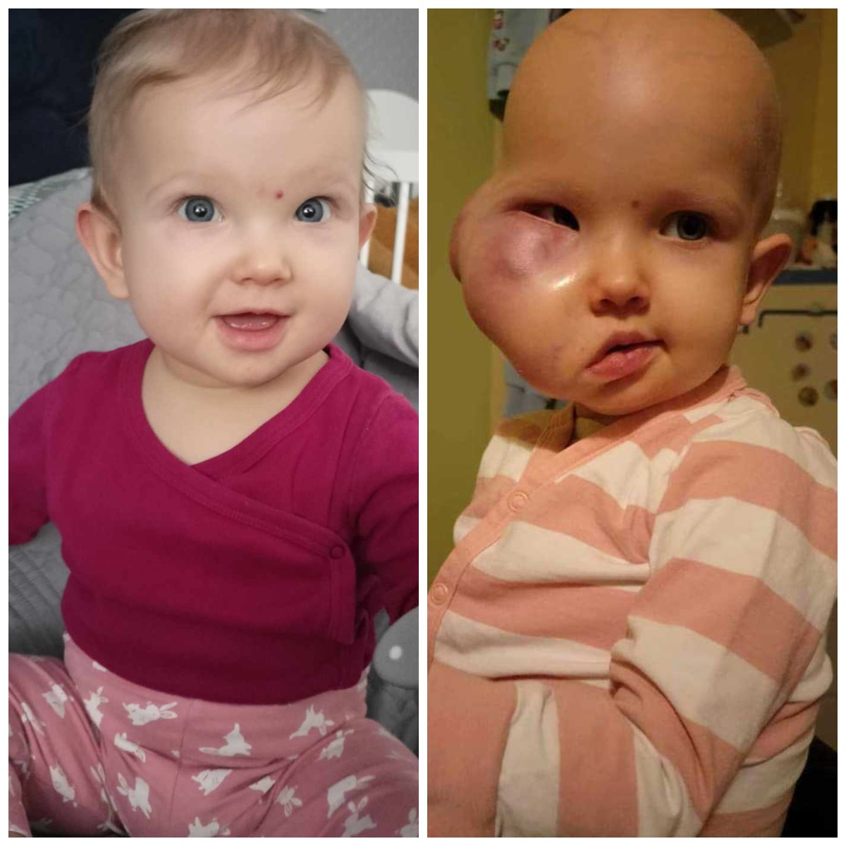 damian_zurawski's tweet photo. Marcelinka ma zaledwie 19 miesięcy, złośliwy nowotwór dosłownie zjada jej twarz, z dnia na dzień jest coraz większy..💔 Błagam o RT.🙏

W marcu zeszłego roku, 10-miesięczna Marcelinka upadła niefortunnie na prawy policzek. To, co początkowo wydawało się zwyczajnym upadkiem, okazało się dramatem, który uruchomił walkę o życie dziecka.
Po kilku dniach pojawił się niepokojący obrzęk na policzku, a próby leczenia nie przyniosły skutku. Rodzice podjęli decyzję o biopsji, aby znaleźć odpowiedzi na dręczące pytania dotyczące zdrowia Marcelinki.

W dniu swoich pierwszych urodzin Marcelinka trafiła do szpitala z powodu ropnia po biopsji. Zamiast zdmuchnąć świeczkę na tortcie, usłyszała diagnozę: nowotwór złośliwy głowy i szyi. Świat dla rodziców się zatrzymał, a zamiast świętować, pakowali walizkę na onkologię. 

To bezbronne maleństwo nie powinno być zaznajamiane z zapachem onkologii, znosić chemioterapię, ogromny ból i cierpienie...

Choć przygotowujecie się do Sylwestra, proszę, spojrzyjcie na te dwie fotografie, które dzieli zaledwie 9 miesięcy. 
Z lewej strony uśmiechnięta dziewczynka, a z prawej strony niewyobrażalne cierpienie. 
Możemy zakończyć to cierpienie jeszcze przed końcem roku. 
Każda wpłata ma znaczenie, ale jeszcze ważniejsze jest polubienie i udostępnienie. 
Twoje kliknięcie otwiera drzwi do wsparcia innych i przyspieszenia zakończenia zbiórki.
Pokażmy wszystkim, jak wspólnie czynimy dobro i sprawiamy mały cud dla Marcelinki. 

Proszę Was, pomóżmy jej!
https://t.co/KWtHqLt9Zo