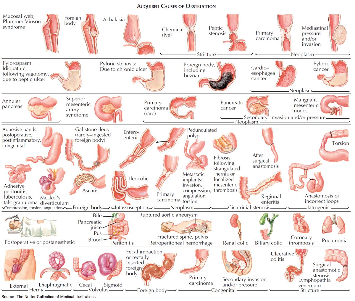 ManualOMedicine's tweet photo. @drsamshuaibi Intestinal Obstruction from Adhesions https://t.co/Yw7TTBPog7