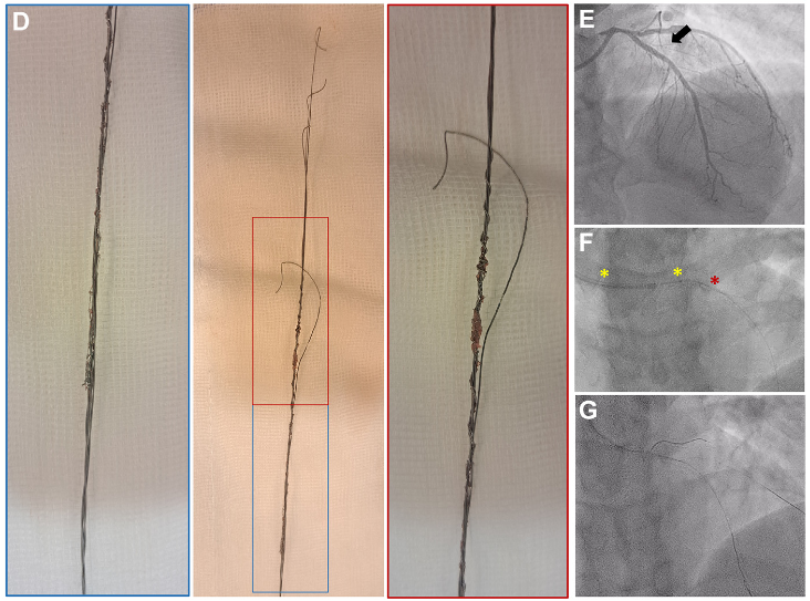 Caring for a patient with a challenging CTO? Then refer him/her to the best CTO operator worldwide: Pierfrancesco Agostoni... Just have a look at this unique case to have a glance at his competence and stamina! sciencedirect.com/science/articl… @AgostoniPF