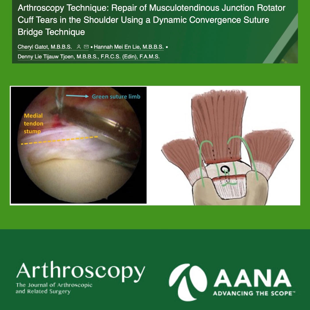 Arthroscopy Technique: Repair of Musculotendinous Junction Rotator Cuff Tears in the Shoulder using a Dynamic Convergence Suture Bridge Technique ow.ly/aHTQ50QlH4q
