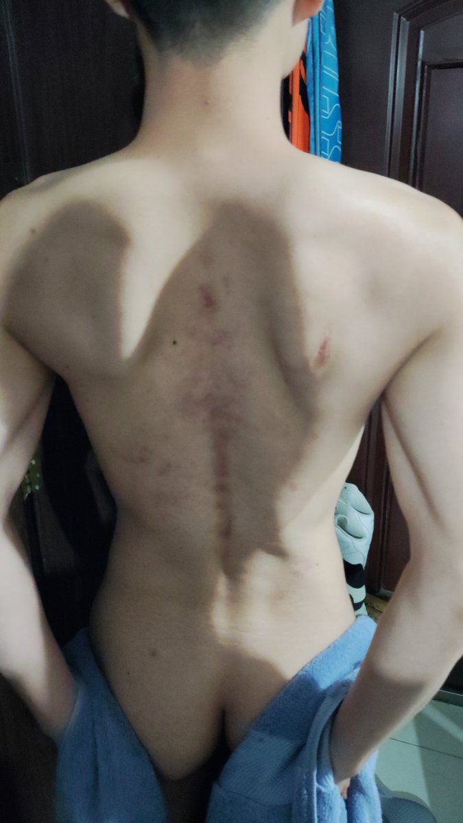 刮了个痧😬😬😬😬