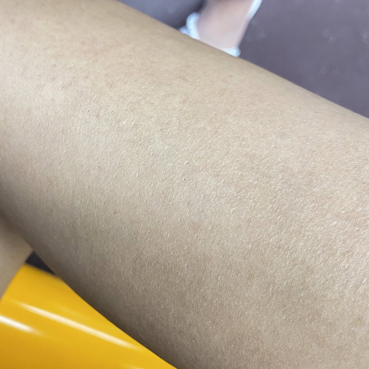 ปกตินี่จะไปให้วิตามินผิวที่กังนัมคลินิก แต่ขนขาขึ้นแข็งฉ่ำมากเลยลองไปทำดู แอบกลัวเพราะเห็นคนรีวิวว่าทำเจ็บแต่พอได้ทำจริงนี่สะใจเฉย งง55 คือมันเป็นความรู้สึกคันๆ จี๊ดๆขาที่ฉันชอบมากเลยอะแล้วพี่พนักงานก็ถามตลอดเวลาว่าโอเคไหมทนได้ไหมงี้ โดยรวมคือประทับใจอะ(นมเปรี้ยวฟรี ไอเริ้บมาก😭