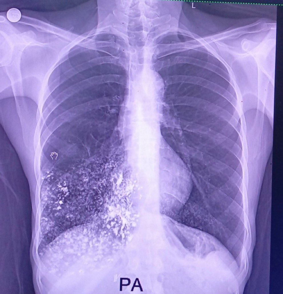 Paul_Wischmeyer's tweet photo. Patient with previous surgery for oesophageal cancer presents with dysphagia and breathlessness. What’s the diagnosis? #TwitterConsult
H/T @drkeithsiau https://t.co/u6EpB3Jmbd