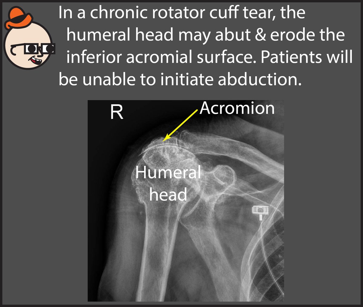This right shoulder is severely abnormal, but why? If you’d like to learn how to read chest X-Rays, check out my comic: radiopaedia.org/courses/chest-…