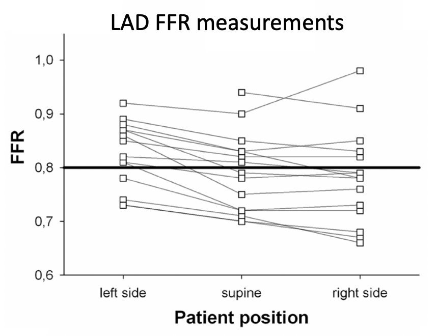 JEscaned's tweet photo. 6) Finally, QFR/muFR values not affected by hydrostatic pressure, but FFR/RFR are! This may explain differences in around-cutoff values. To show the effect, see how FFR values change moving the patient from supine to his/her right / left side! https://t.co/7Lfw7eIGZL https://t.co/XaCrPFAipD