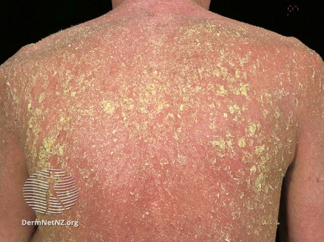 So it's a slightly controversial topic, but most people accept >90% BSA as the definition of erythroderma. But let's be honest - if the patient's pretty red all over, the differential diagnosis is probably similar.

So before we even get to ddx, let's talk consequences:
2/