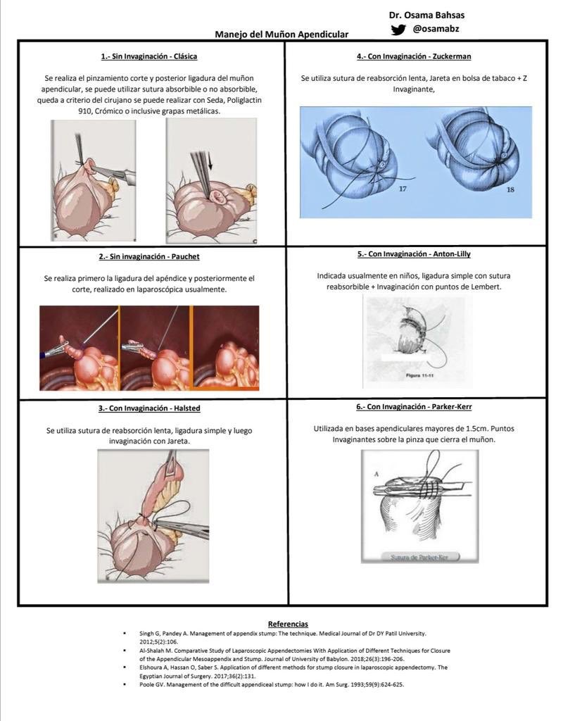 Open surgical techniques without using staplers for the management of a difficult Appendiceal stump! By Dr <a href="/osamabz/">Osama Bahsas</a>: purse string, Z plasty, Halsted, Anton Lilly and Parker Kerr! #SoMe4Surgery <a href="/juliomayol/">Julio Mayol</a> <a href="/SWexner/">Steven D Wexner MD, PhD</a> <a href="/salo75/">Salomone Di Saverio MD PhD FACS FRCS (Eng)</a> <a href="/pferrada1/">Paula Ferrada MD FACS FCCM MAMSE</a> <a href="/PipeCabreraV/">Dr Luis Felipe Cabrera Vargas MD FACS</a> <a href="/sminaev2015/">Sergey Minaev</a>