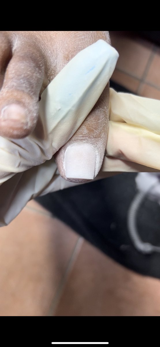 kayyDione's tweet photo. I have i not done enough convincing? DO YOU SEE THE MATERIAL? ๐ฎโ๐จ๐ฅ
โข thatโs a perfect acrylic Toe ๐ค
#Fyp #nails #Feet #Toes #acrylic #toeBBL . https://t.co/d9X7HmI6kD