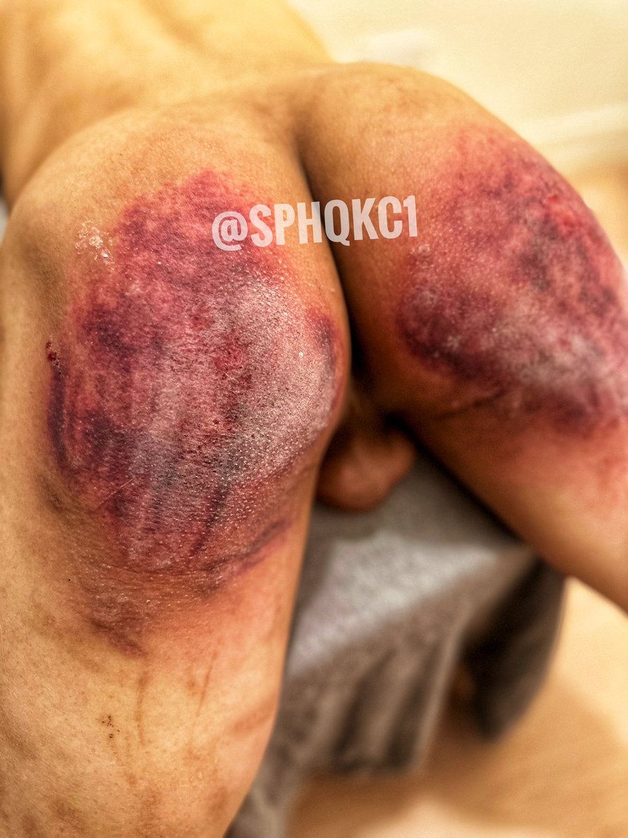 I’ll post videos again after new years if enough retweets😏.  This took 12-13 mins.  If you behave, the spanking may last an hour.  If you don’t, your ass will look like this within 10-12 mins, and then I will continue spanking for the next hour.  #spanking #sphqkc1 #打屁股 #bdsm
