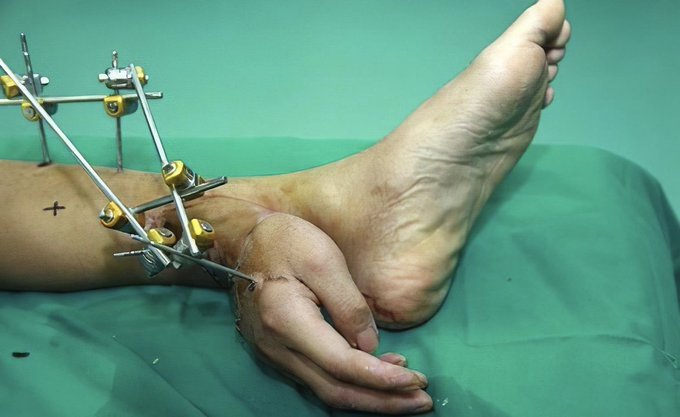 fasc1nate's tweet image. In 2013, a remarkable medical procedure was performed on Chinese factory worker Xie Wei, where his hand was temporarily attached to his left ankle to maintain its viability, utilizing the blood supply from his leg.  

Although the hand was warm, it was numb due to the absence of…