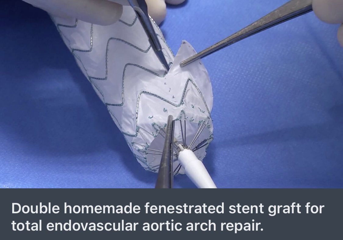 Most views ②⓪②③ | #Vascupedia  2nd Place 🥈| Double homemade fenestrated stent graft for total endovascular aortic arch repair Ludovic Canaud 🇫🇷 lnkd.in/euT4_p57 @AortaSurg @farkomd @_backtable @DrZeigler1 @ctsnetorg @DeBakeyCVedu #AortaED #education #Vascupedia