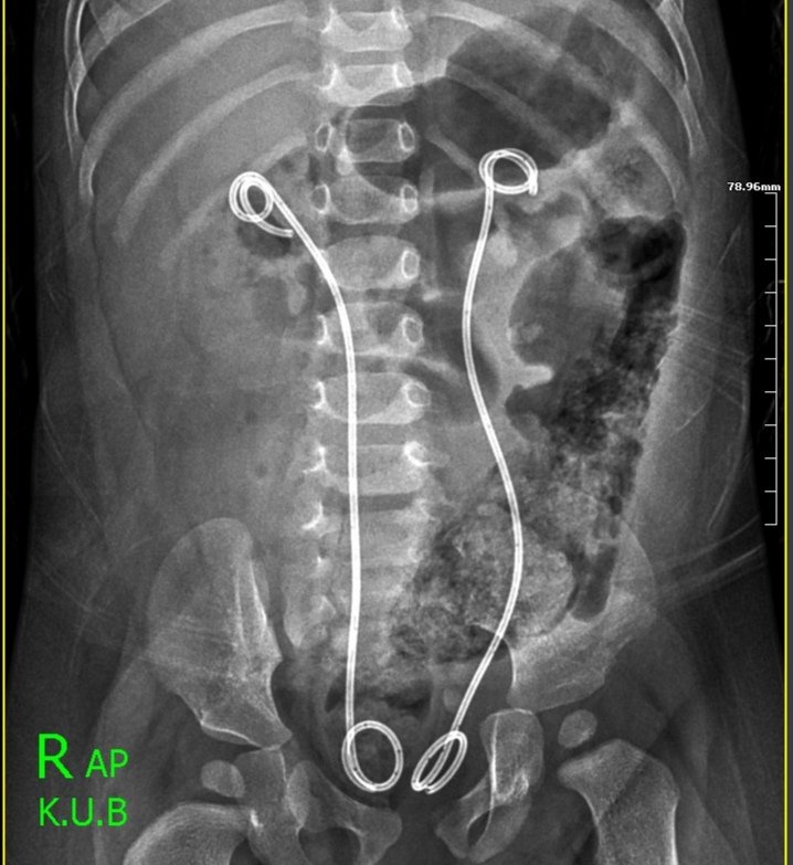 Salah Nagla (@dr_salah_nagla) on Twitter photo 12 months female infant with calculus anuria due to bilateral renal & ureteric stones. Serum creatinine 6. DJ. stents inserted. So, what's the age of your youngest patient that had a claculus anuria? <a href="/saudi_peduro/">Saudi Ped Uro</a> <a href="/YPedUrolClub/">Young Pediatric Urologists Club</a> <a href="/Endo_Society/">Endourological Society</a> <a href="/mohamed92902484/">mohamed elshazly</a> <a href="/Mohamedendourol/">Mohamed_omar</a> 12 months female infant with calculus anuria due to bilateral renal & ureteric stones. Serum creatinine 6. DJ. stents inserted. So, what's the age of your youngest patient that had a claculus anuria? <a href="/saudi_peduro/">Saudi Ped Uro</a> <a href="/YPedUrolClub/">Young Pediatric Urologists Club</a> <a href="/Endo_Society/">Endourological Society</a> <a href="/mohamed92902484/">mohamed elshazly</a> <a href="/Mohamedendourol/">Mohamed_omar</a>