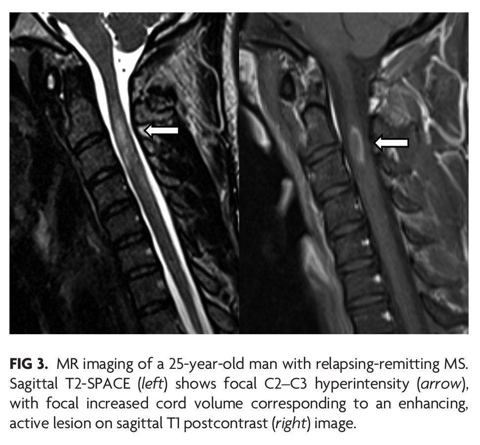 AJNR (@theajnr) on Twitter photo "Accuracy of Noncontrast T2 SPACE in Active MS Cord Lesion Detection" #MultipleSclerosis <a href="/The_ASSR/">American Society of Spine Radiology (ASSR)</a> <a href="/AnoushehSayah/">Anousheh Sayah</a> | ajnr.org/content/44/12/… "Accuracy of Noncontrast T2 SPACE in Active MS Cord Lesion Detection" #MultipleSclerosis <a href="/The_ASSR/">American Society of Spine Radiology (ASSR)</a> <a href="/AnoushehSayah/">Anousheh Sayah</a> | ajnr.org/content/44/12/…