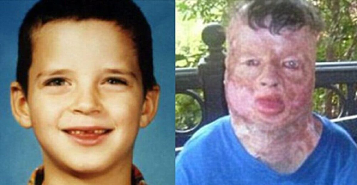 Robbie Middleton was just eight years old when he was tied to a tree, doused with gasoline, and set on fire by a 13-year-old neighbor in Splendora, Texas. Despite surviving the attack, Robbie suffered burns over 99% of his body and endured years of medical treatment before he