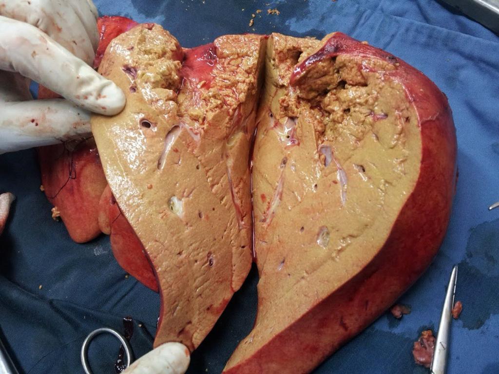 Gentle reminder on what alcohol does to the inside of your liver, even with occasional/low, moderate or high quantity drinking. Normal lovely baby pink inside is replaced by dirty, disgustingly thick oily yellow** fatty deposits that traverse across the organ affecting it's…