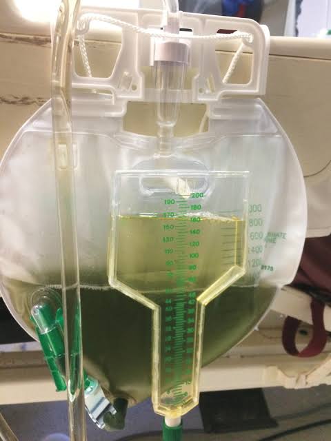 Urine colour of an intubated patient on IV infusion of a drug.

Culprit Drug?