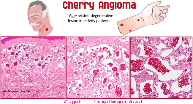 schowardjd's tweet photo. @Sthanu5 Cherry angioma (Campbell de Morgan spots)

DDx: angiokeratoma, spider telangiectasis, pyogenic granuloma, nodular BCC, amelanotic melanoma

[image source: @DrSampyRoy, #RoyPath, https://t.co/JNDM8Tnfpn] https://t.co/gyF5tBw2uO