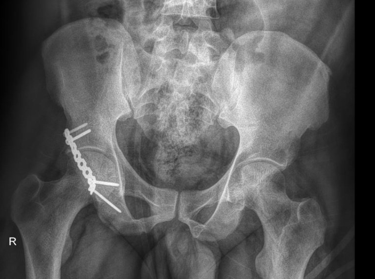 Last 2 cases of the year 🤞 .I give thanks to the Almighty for the guidance and protection 🙏 (One had to be a Pelvis)