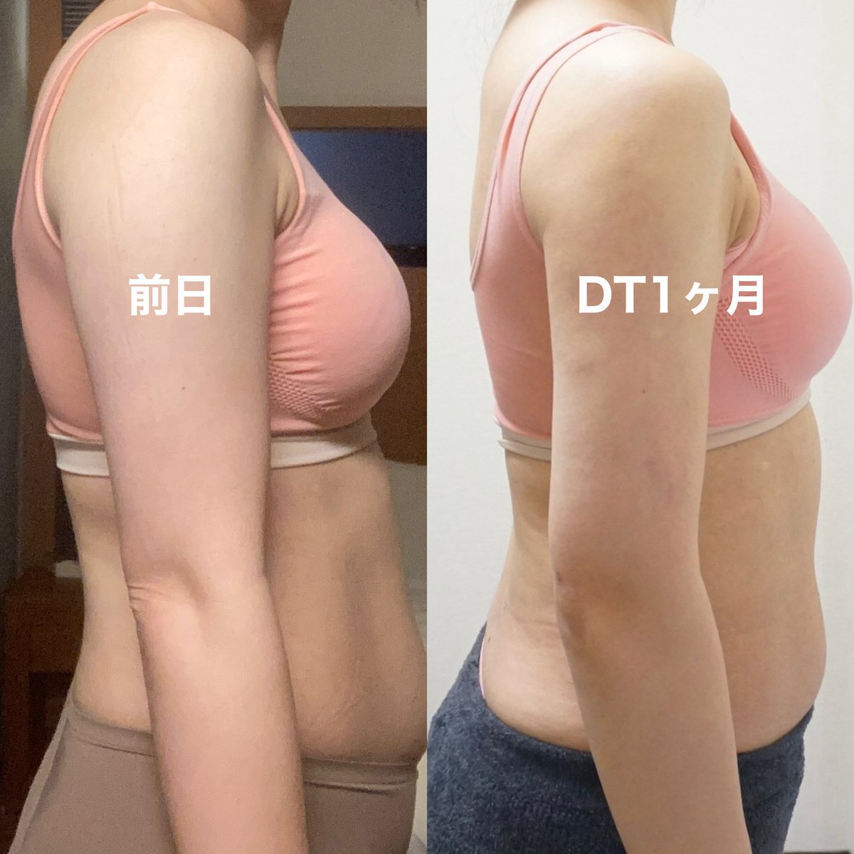 py55257's tweet photo. 狎鴎亭トップラインさんで
二の腕と背中とラブハンドル脂肪吸引
DT1ヶ月目🇰🇷

拘縮の凹凸はあるけど
背中も腕もラインまっすぐで嬉しい☺️

でも肩甲骨とかまだがっつり肉つかめる😥
食事制限がんばる時期��

#二の腕脂肪吸引 #背中脂肪吸引
#狎鴎亭topline #脂肪吸引ダウンタイム

@aptopline1675 https://t.co/UymKbguqTo