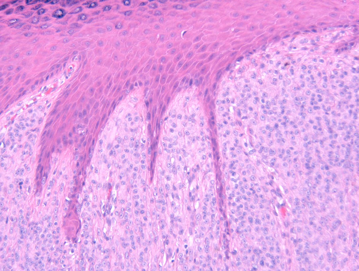 RACARR51's tweet photo. RAC8980: M50s dorsum hand, 3 years ?DF. 1st (GMT) case of 2024!!! Happy new year. #dermpath https://t.co/t4Uv7Gg3cm