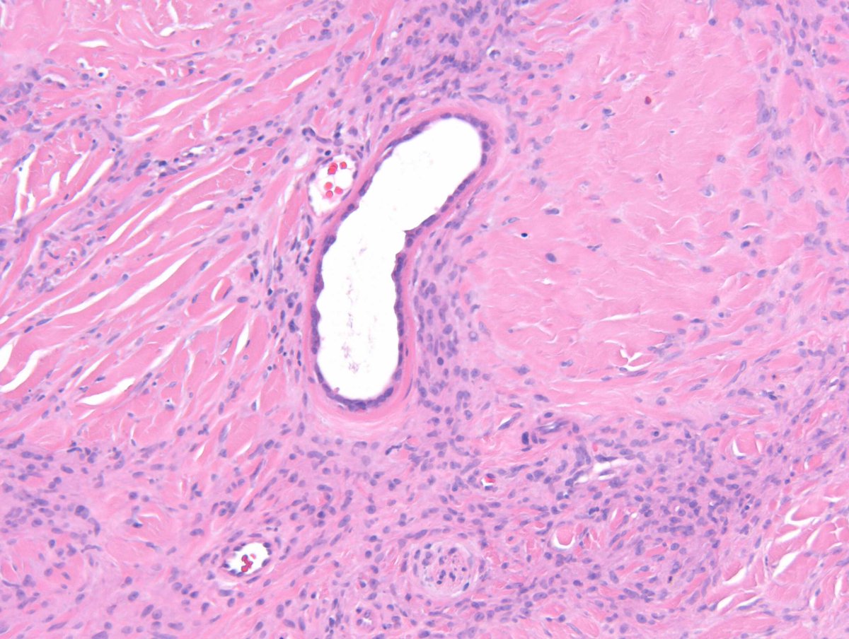RACARR51's tweet photo. RAC8980: M50s dorsum hand, 3 years ?DF. 1st (GMT) case of 2024!!! Happy new year. #dermpath https://t.co/t4Uv7Gg3cm