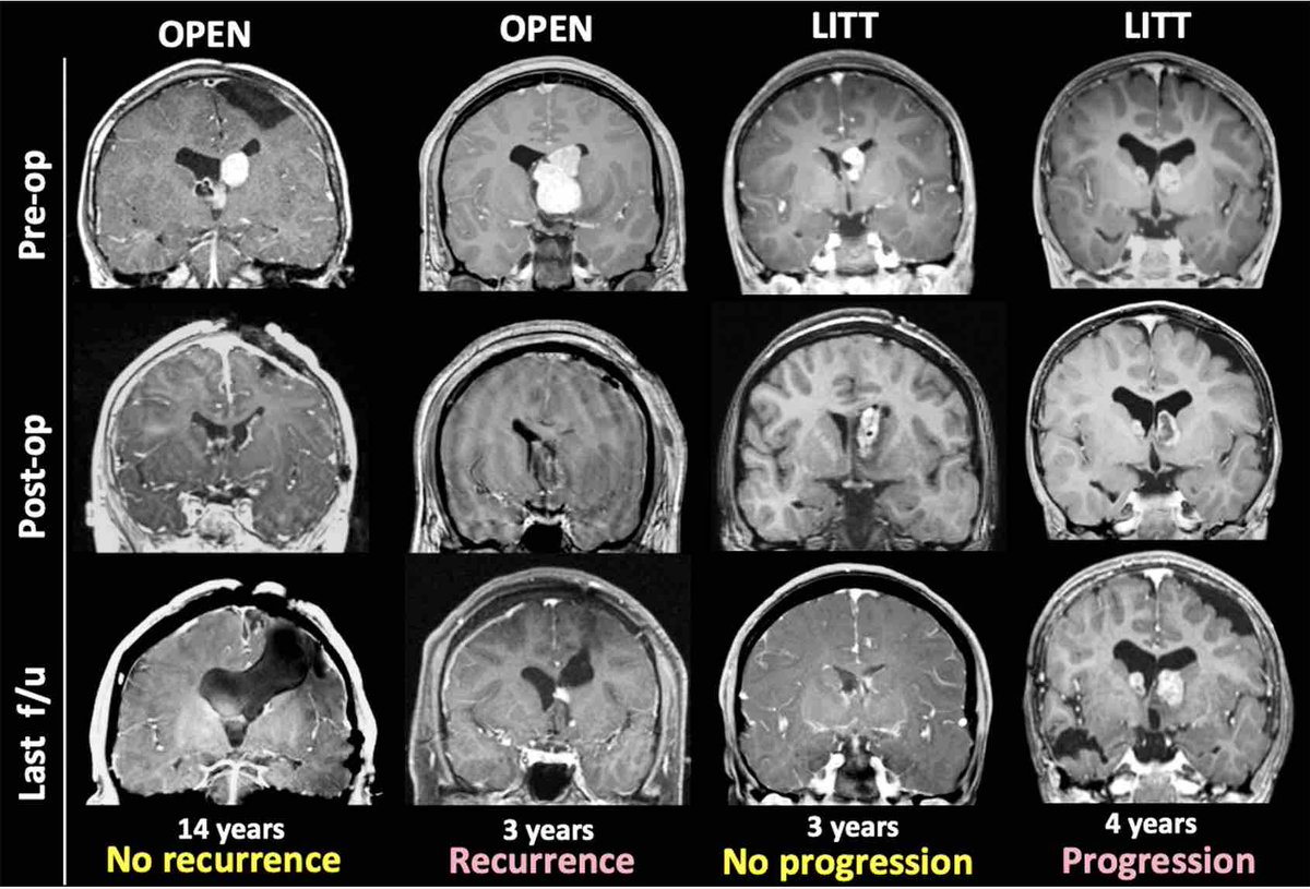 #OnlineFirst: Laser interstitial thermal therapy compared with open resection for treating subependymal giant cell astrocytoma.
thejns.org/pediatrics/vie…