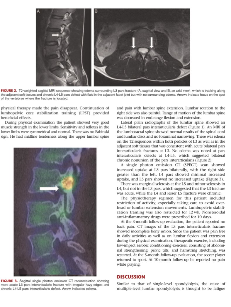 ⚽🤕Case report: successful conservative treatment of a soccer player with multiple-level spondylolysis

journals.lww.com/c-orthopaedicp…