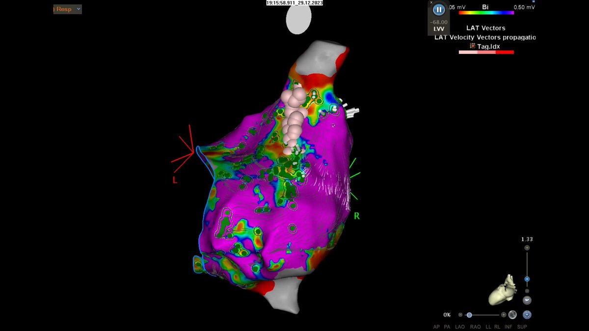 Indeed, only a circuit around the ASD repair. A first lesion in the critical isthmus between the SVC and the ASD repair terminated it. Finally, some further ablation to consolidate and confirm block. <a href="/EpCardiac/">Brighton Cardiac EP</a> #EPeeps