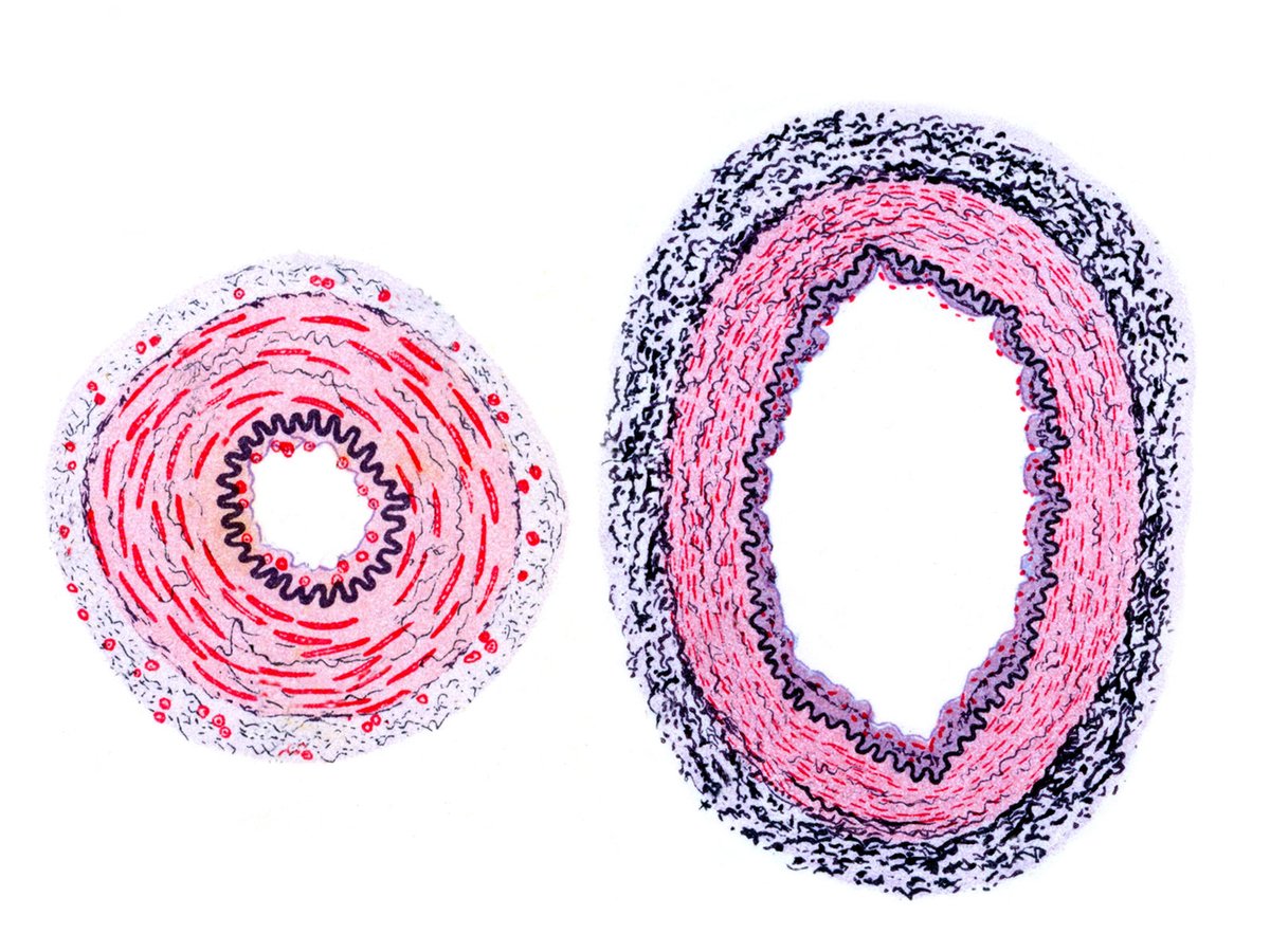 In a model of #GouldSyndrome, researchers connected brain lesions and hemorrhages to disruptions in #CalciumSignaling in smooth muscle cells from misfolded collagen, impairing vessel’s ability to regulate blood flow. <a href="/UCSFGouldLab/">Gould Lab UCSF</a> <a href="/CobreUnr/">UNR Cardiovascular COBRE</a> 

📄: scim.ag/5mK