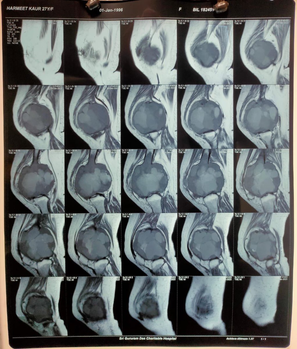 DrDardi's tweet photo. Starting the 2024 with a good case 

1. 3 YEAR OLD GIANT CELL TUMOR OF DISTAL FEMUR  FOR EXCISION AND MEGA PROSTHESIS . https://t.co/Krl3K1jAPa