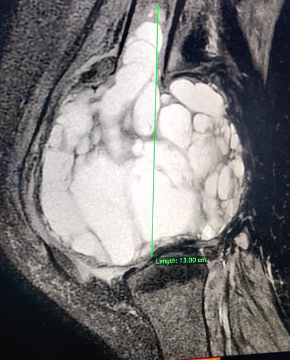 DrDardi's tweet photo. Starting the 2024 with a good case 

1. 3 YEAR OLD GIANT CELL TUMOR OF DISTAL FEMUR  FOR EXCISION AND MEGA PROSTHESIS . https://t.co/Krl3K1jAPa