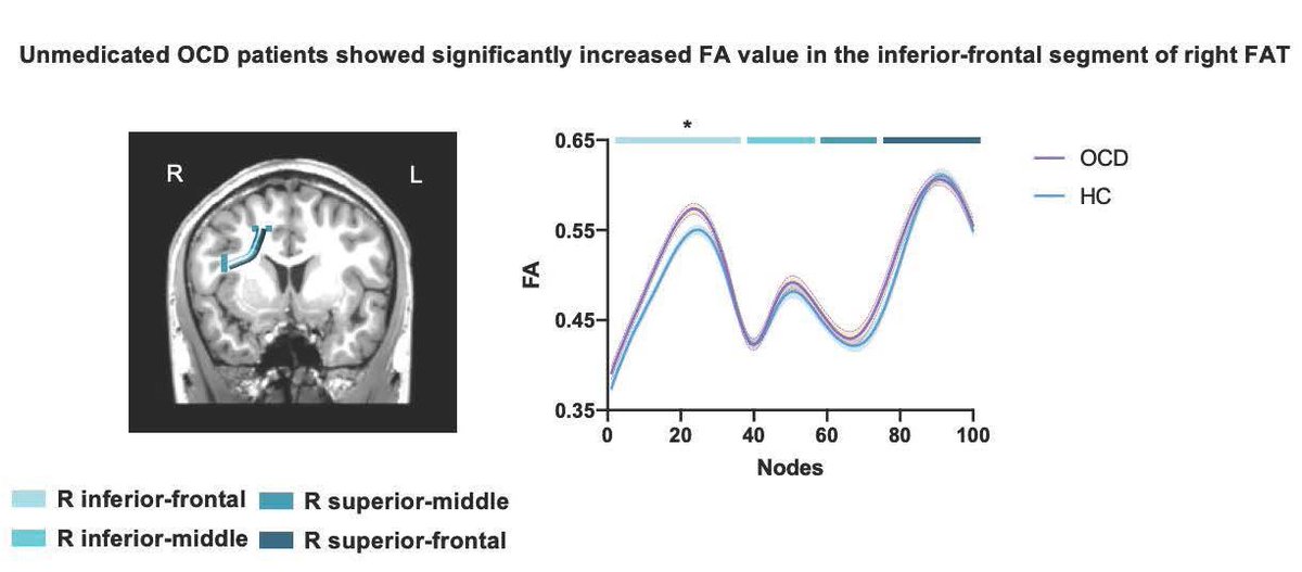 SfN Journals (@sfnjournals) on Twitter photo According to #JNeurosci research from <a href="/gluorokana/">Danni Wang</a>, Fan et al. <a href="/sjtu1896/">Shanghai Jiao Tong University</a> <a href="/NIDAnews/">NIDAnews</a>, the frontal aslant tract, known to connect cortical structures of the brain, may accurately predict individuals’ cognitive capacity and neurological disease severity.
jneurosci.org/lookup/DOI/10.… According to #JNeurosci research from <a href="/gluorokana/">Danni Wang</a>, Fan et al. <a href="/sjtu1896/">Shanghai Jiao Tong University</a> <a href="/NIDAnews/">NIDAnews</a>, the frontal aslant tract, known to connect cortical structures of the brain, may accurately predict individuals’ cognitive capacity and neurological disease severity.
jneurosci.org/lookup/DOI/10.…