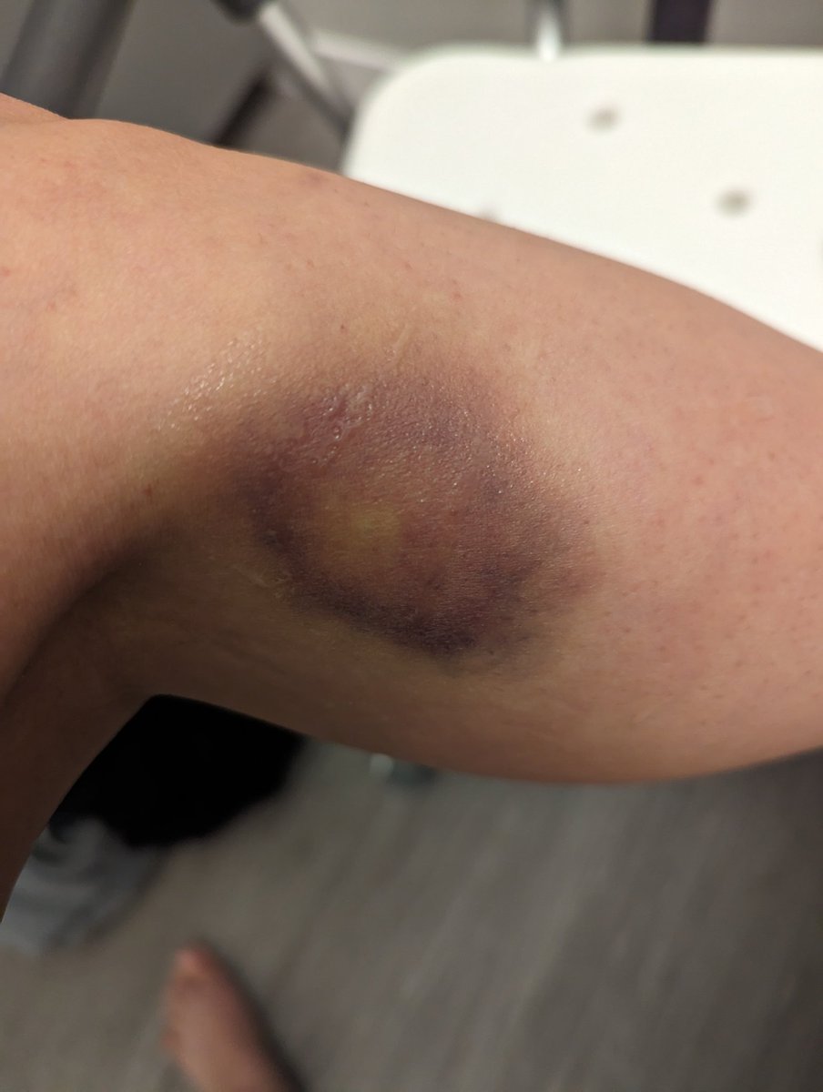 evilbytess's tweet photo. New years resolution is to stop getting these zombie bite looking ass bruises... Come on, man! It has been over a month! HEAL ALREADY!!!!! 😩 https://t.co/ZmYzACZdCN