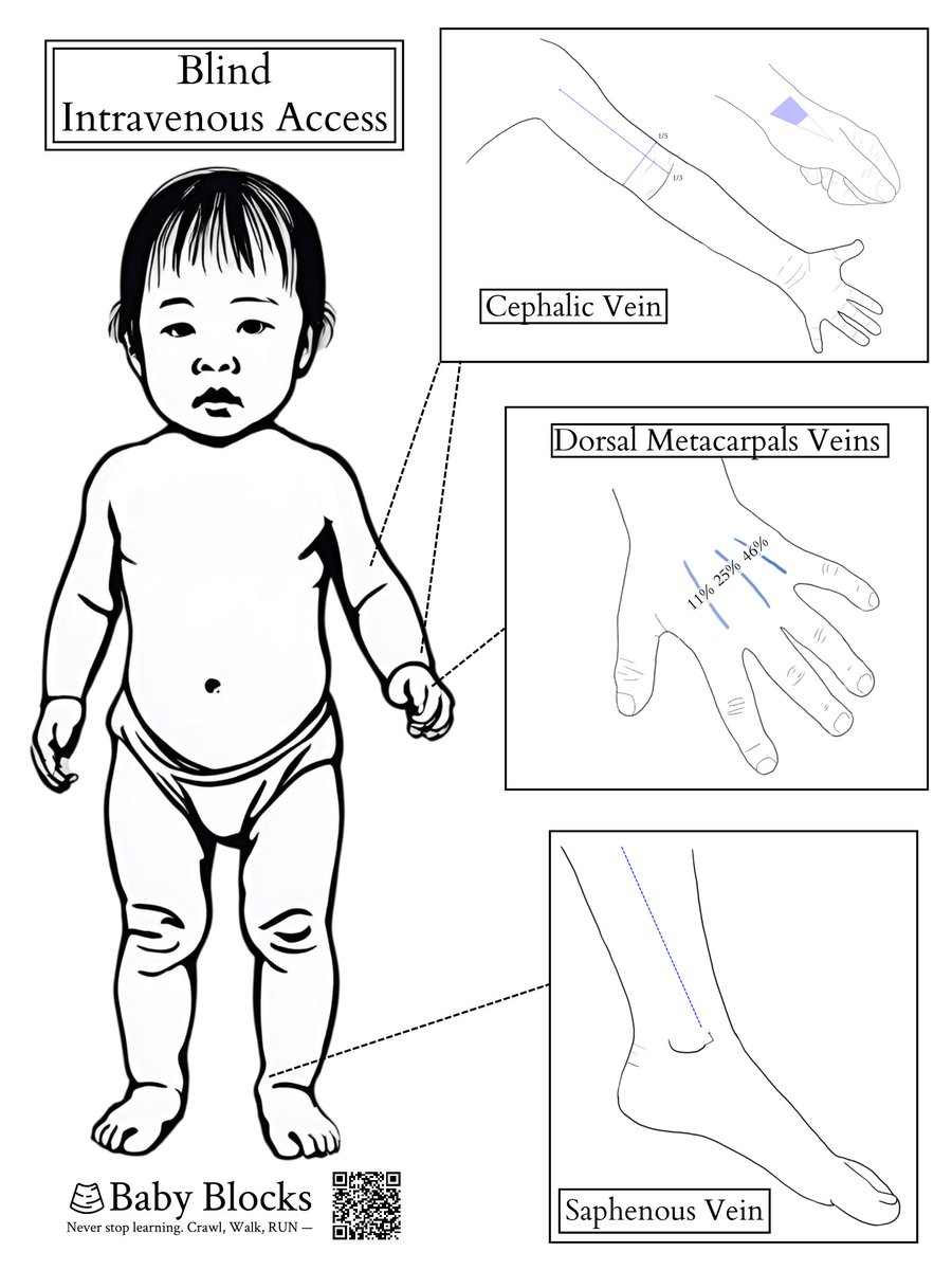 baby_blocks's tweet image. As we hunker down for the season, we offer one final gift, an homage to our most popular page, blind IV access: A new printable PDF for quick and easy access.
And no, the irony isn't lost on us.
baby-blocks.com/vascular-acces…
#PedsICU #pedsRN #pedsED #pedsanesthesia #pediatrics