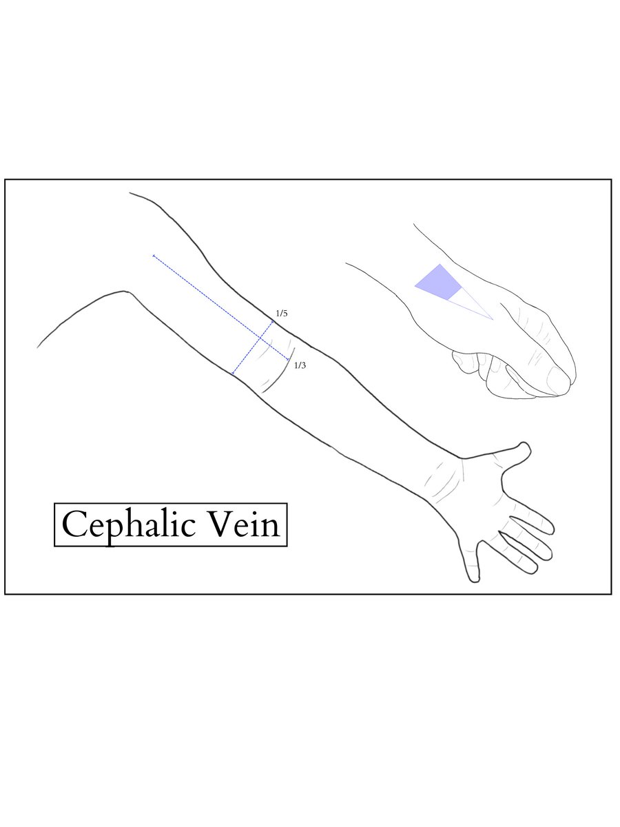 baby_blocks's tweet image. As we hunker down for the season, we offer one final gift, an homage to our most popular page, blind IV access: A new printable PDF for quick and easy access.
And no, the irony isn't lost on us.
baby-blocks.com/vascular-acces…
#PedsICU #pedsRN #pedsED #pedsanesthesia #pediatrics
