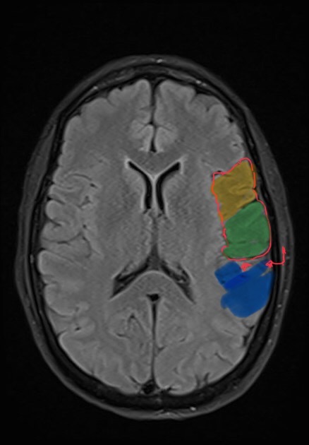 Broca's area 44 is tricky to find on imaging.

Yellow: area 44 frontal lobe
Green: lower sensory ribbon of the parietal lobe
Blue: temporal lobe
Red star: Sylvian Fissure

"Behind the Sylvian is temporal..afront of it is Frontoparietal".

#SaturdayNight_Neuroimaging