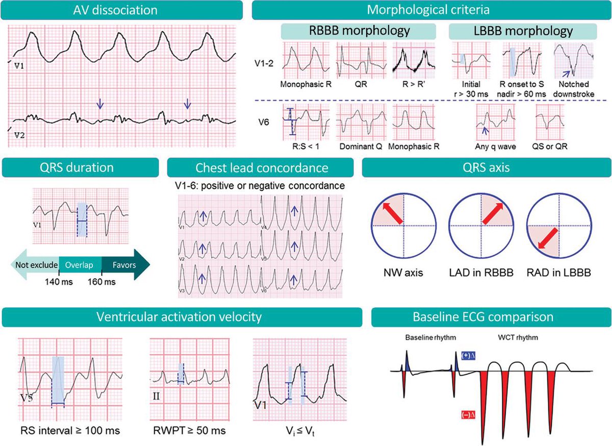 Is that wide complex tachycardia actually VT? VT rule-in criteria ⚡️👇 A #BacktoBasics review 📚