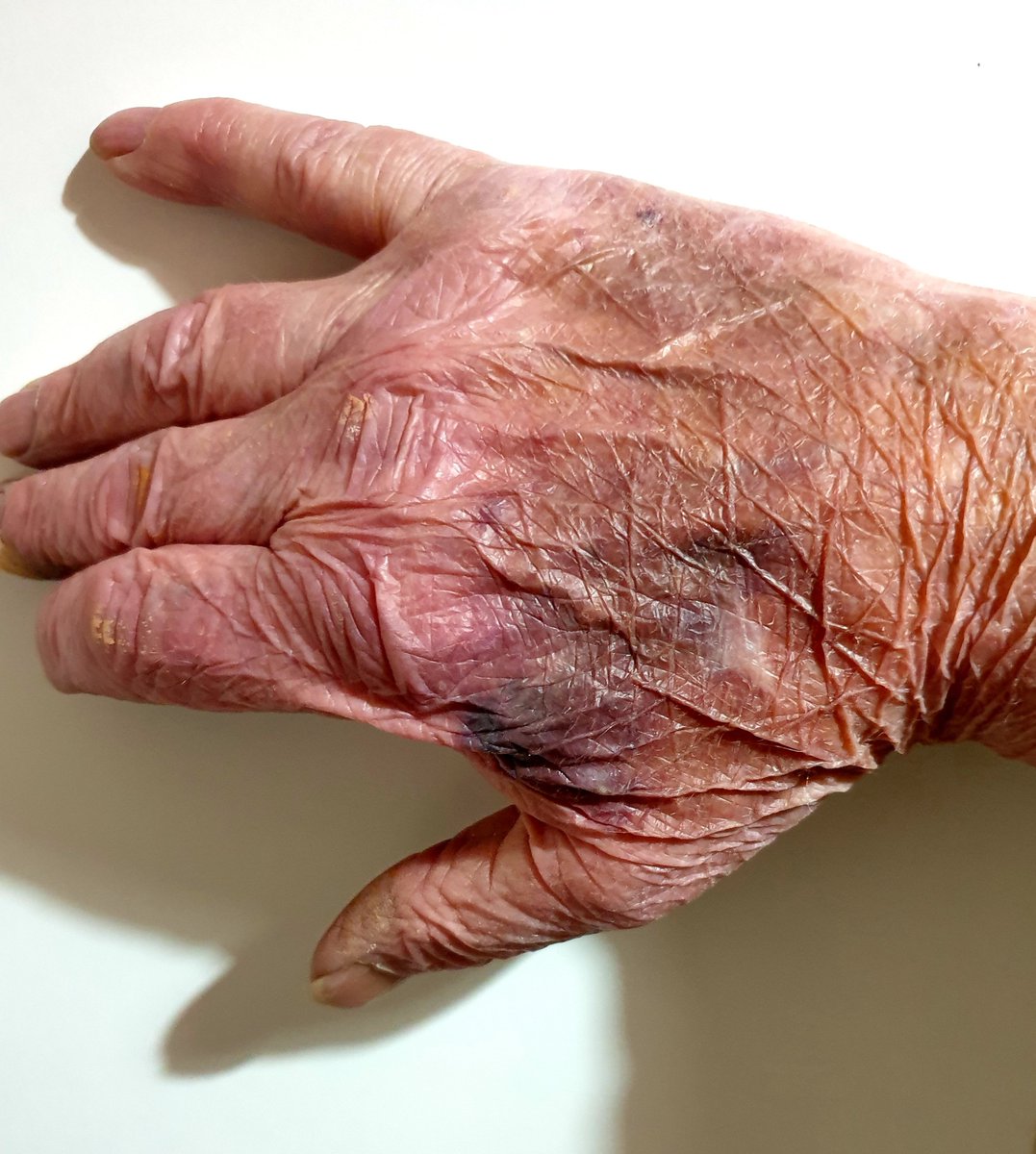 FredFli80762995's tweet image. Agreed #disabilitys  in all its formats is not age related