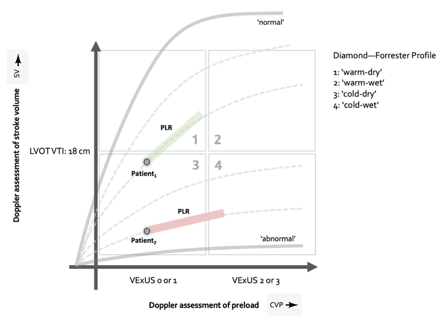 1/7: This year, let's fully understand the concepts of fluid responsiveness, fluid tolerance, venous congestion, dynamic fluid intolerance, and perfusion. This is crucial for all providers as dedicated RCTs (1500 pts!) (@AndromedaShock 2) will help inform how to integrate…