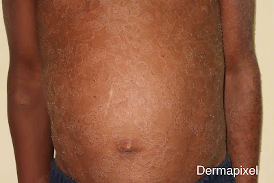 SCPed's tweet photo. 🧐"Un caleidoscopio en la piel", cas de dermatologia pediàtrica al blog #Dermapixel de @rosataberner https://t.co/bwnwgvv95M https://t.co/IAM1aH9kXG