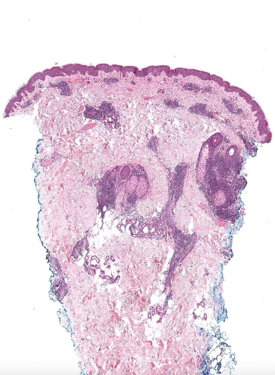 JMGardnerMD's tweet photo. 30 F chest. Red firm plaque. Diagnosis?
WSI digital slide &amp; Answer ✅ 🔬 https://t.co/Wmdy3jd8Rk 
Video ⏯️ https://t.co/KM2AXLFLZw 
Ddx: https://t.co/eDQxcxQBpT
Inflammatory #dermpath 101 https://t.co/6UusDZeA9T
#pathology #pathologists #pathTwitter #dermatology #dermtwitter https://t.co/SxJEC2ZbZW
