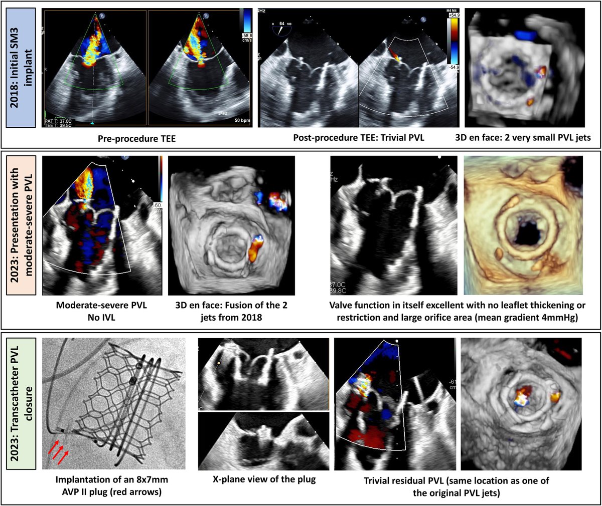 In this first long-term follow-up report of #TMVR with the SM3 device, there was normal prosthetic leaflet function with no sign of degeneration at 5 years. bit.ly/3tva243 #JACCINT @AliSahebHusain @myriam_akodad @David_Meier_
