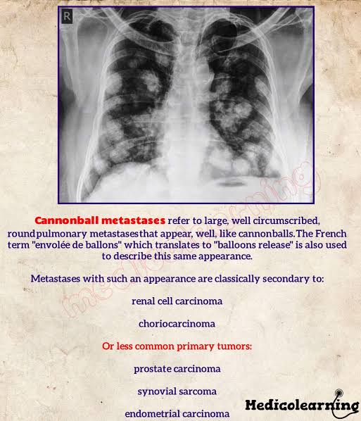 @modernHealthMe Cannonball Metastases mostly from GI Malignancy