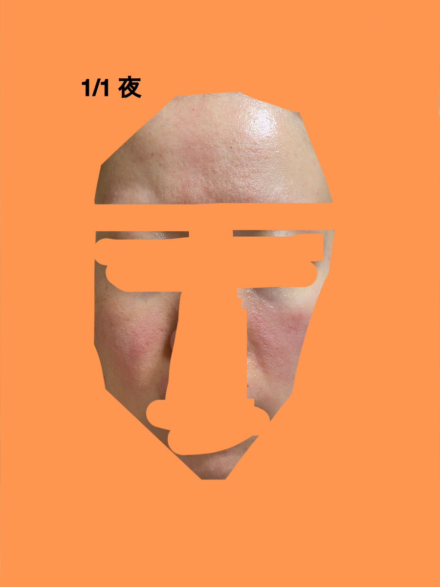 nn0_0nnn's tweet photo. いつものことながら実家に帰ると肌が荒れる。
猫アレルギー
ハウスダストアレルギー

顔痒すぎて眉間に皺😂
かゆいよー😭😭😭
痒いところがはっきり赤い。

アレルギー症状出てる時、なぜかほうれい線もくっきりな気がする。 https://t.co/563J4TO0hB