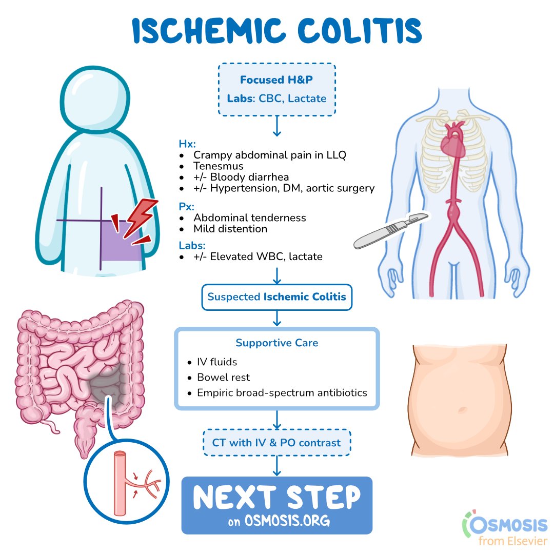 Today's #DecisionTreeBranch walks through diagnosing ischemic colitis, which is typically caused by reduced intestinal blood flow. Stable patients usually report rapidly developing abdominal pain in the left lower quadrant.

Next steps: osms.it/dtb-ischemic-c…