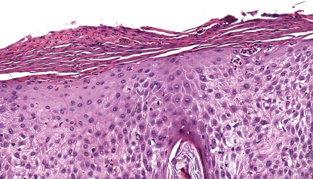 JMGardnerMD's tweet photo. Solitary red papule. Diagnosis? (This one is as classic as it gets!) 
Digital slide &amp; Answer 🔬 ✅ https://t.co/2xqDWkepDA 
Videos ⏯️ https://t.co/jIc4Wrhjcf &amp; https://t.co/f1KUvd9JhV
#pathology #pathologists #pathTwitter #dermpath #dermatology #dermatologia #dermtwitter https://t.co/PS7ELeCKmY