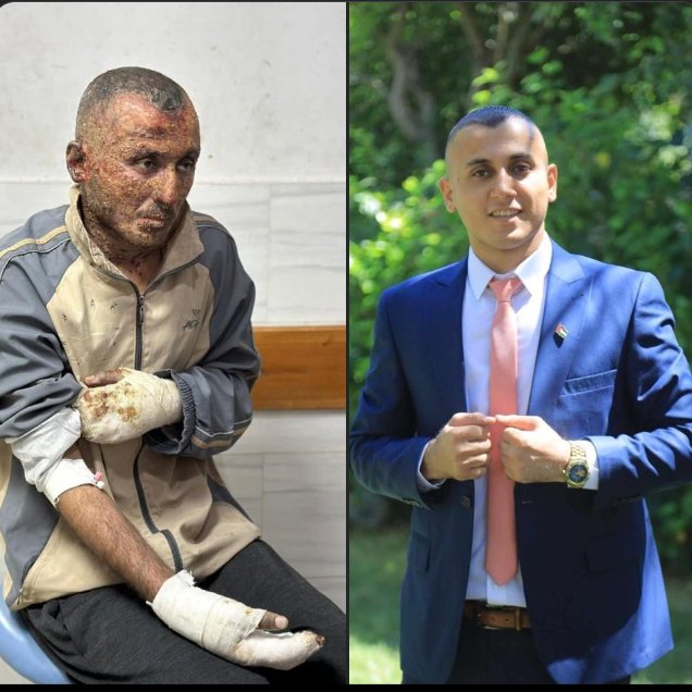 Palestinian journalist Hamza Hammad sustained injuries from an Israeli incendiary bomb while carrying out his work in northern #Gaza, resulting in disfiguring marks across his body.

#GazaGenocide 
#journalismmatters